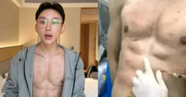 بعيداً عن الجيم.. مؤثر صيني يدفع 560 ألف دولار مقابل عضلات بطن وهمية بالهيالورونيك.