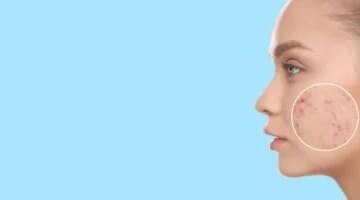 حب الشباب بعد الثلاثين حين تكون الهرمونات هي المتهم الأول