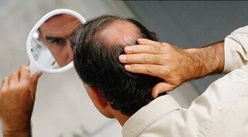 علاج الصلع في 20 يومًا دراسة تكشف عن مصل يعيد