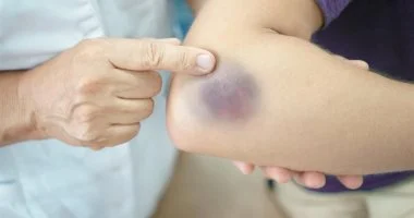 كدمات مرضى السكري: ارتباط مباشر بتلف الأوعية الدموية ومؤشر على ضعف التحكم بالمرض.