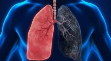 للحد من خطر سرطان الرئة 4 إجراءات وقائية يتجاهلها معظم