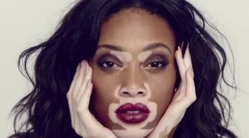 ليست كل بقعة بيضاء بهاق طبيب يحدد العلامات الفارقة لتشخيصها