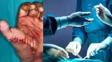 من ساقه المبتورة إلى يده إصبع قدم يُزرع كإبهام ويعيد