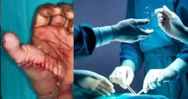 من ساقه المبتورة إلى يده.. إصبع قدم يُزرع كإبهام ويعيد لشاب قدرته على الإمساك بالأشياء